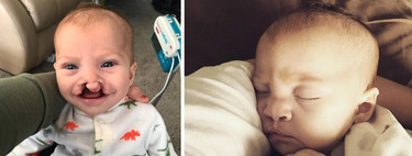 Una persona anónima paga la operación de fisura labial de un bebé tras ver que se burlaban de él en las redes