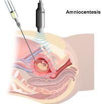 Un estudio sugiere que la amniocentesis no es tan peligrosa como se creía
