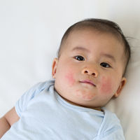 La 'enfermedad de la bofetada' o el eritema infeccioso: todo sobre su contagio, síntomas y tratamiento