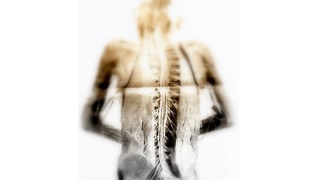 Los hombres también pueden sufrir osteoporosis
