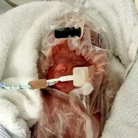 Un bebé prematuro de 600 gramos logra sobrevivir gracias a meterlo en una bolsa de plástico