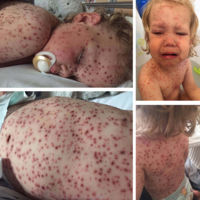 Otra mamá comparte la reacción de la varicela en su hijo y pide que todos los niños puedan vacunarse