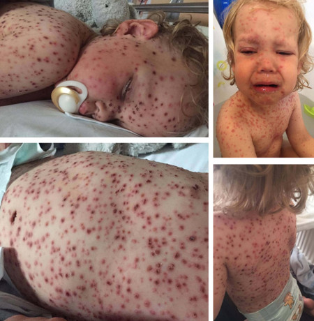 Otra mamá comparte la reacción de la varicela en su hijo y pide que todos los niños puedan vacunarse