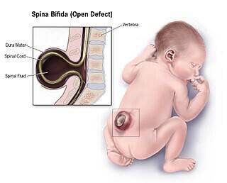 Espina Bifida