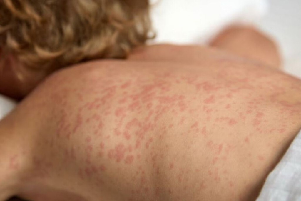 Argentina tiene cuatro brotes activos de sarampión y los expertos ruegan vacunar a los niños: dónde se aplican las dosis 