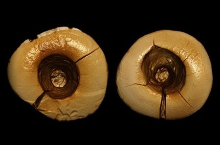 ¿Ya había empastes dentales hace 13.000 años?