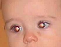 Cornea arificial trasplantada a un bebé de 7 semanas