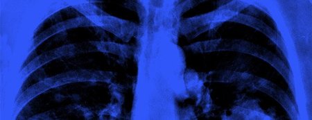 Cuba lanza un nuevo tratamiento contra el cáncer de pulmón