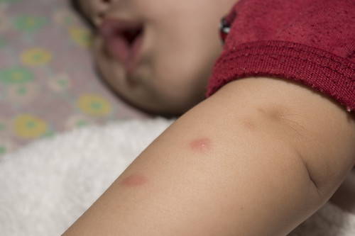 Estos son los bichos que pueden picar a tus hijos este verano: cómo evitarlo y tratar las picaduras