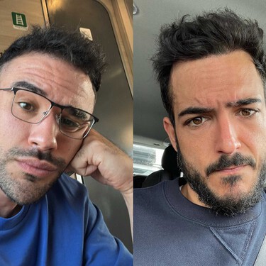 IlloJuan crea polémica con su nuevo injerto de pelo: afirma que "tomar medicación de por vida es mentira". Ahora un experto en trasplantes capilares lo desmiente